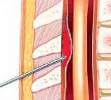 Spinal zewnątrzoponowe krwotok