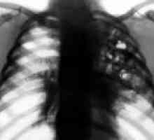 Gronkowcowe zapalenie płuc