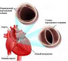 Nabyta zwężeniem aorty (zwężeniem aorty)