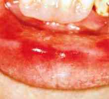Zapalenie jamy ustnej: fotografia, objawy, leczenie
