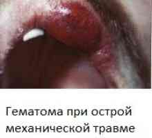 Ustnej (zapalenie jamy ustnej) ze zdjęciami