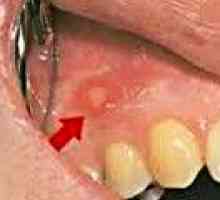 Zapalenie jamy ustnej