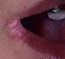 Pęknięcia „perleches” w kącikach ust