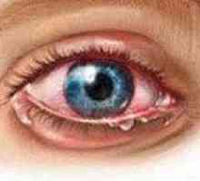 Zapalenie błony naczyniowej oka