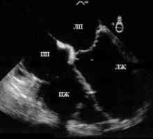 USG serca (echokardiografia)