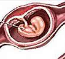 Ciąża pozamaciczna