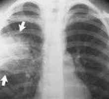 Szpitalne zapalenie płuc