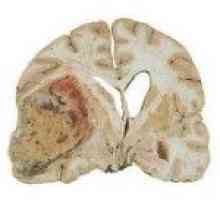Wewnątrzmózgowe guzy półkul mózgowych
