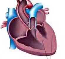 Kardiomiopatia wtórna