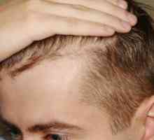 Wypadanie włosów u mężczyzn: przyczyny, leczenie, środki