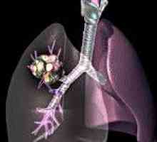 Złośliwe nowotwory płuc