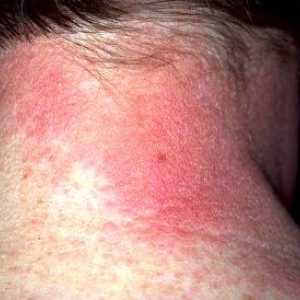 Alergiczne zapalenie skóry: objawy i leczenie