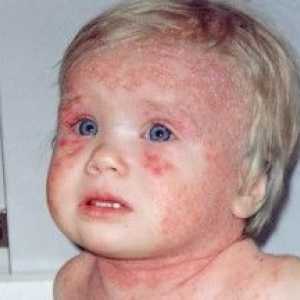 Atopowe zapalenie skóry u dorosłych i dzieci