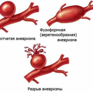 Tętniak tętnicy nerkowej