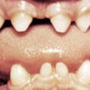 Nieprawidłowości postaci zębów
