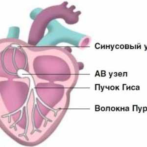 Arytmia serca