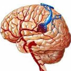 Malformacje tętniczo mózgu