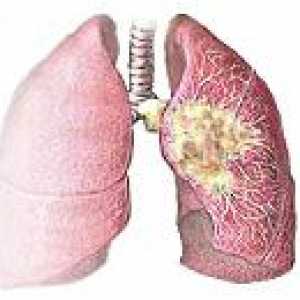 Centralny rak płuc