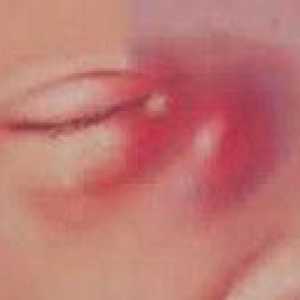 Noworodkowe zapalenie woreczka łzowego