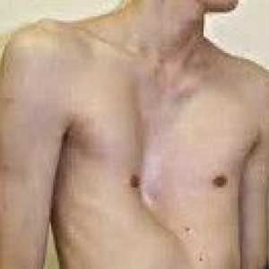 Deformacja klatki piersiowej u dzieci