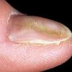 Deformacja paznokci