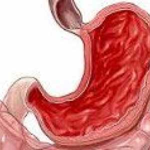 Rozrost błony śluzowej żołądka
