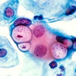 Chlamydia: objawy i leczenie