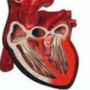 Idiopatyczne zapalenie mięśnia sercowego Abramov-Fiedler