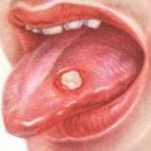 Wrzodziejące zapalenie jamy ustnej
