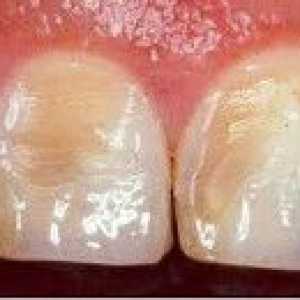 Erozja dentystyczny