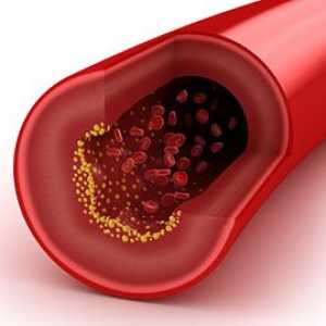 Jak obniżyć poziom cholesterolu we krwi?