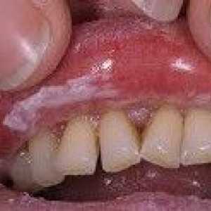 Kandydoza jamy ustnej