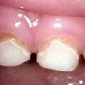 Leczenie zębów mlecznych