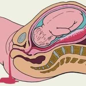 Krwawienie w czasie ciąży we wczesnych i późnych stadiach