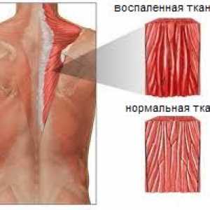 Mięśnie zapalenie mięśni grzbietu i karku
