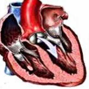 Niedomykalność zastawki aortalnej oraz defekt