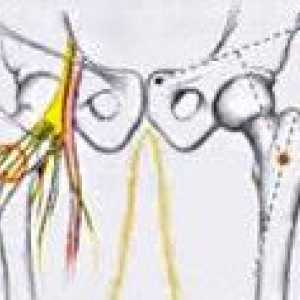 Neuropatia nerwu udowego