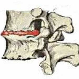 Osteochondroza