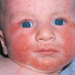 Alergie pokarmowe u dzieci