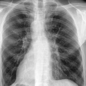 Objawy zapalenia płuc, objawy, leczenie zapalenia płuc płuc