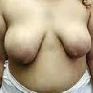 Deformacja piersi