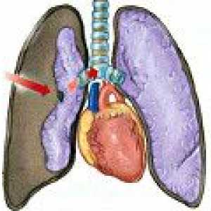 Uszkodzenie płuc
