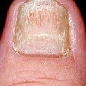 Łuszczyca paznokci na dłoniach i stopach