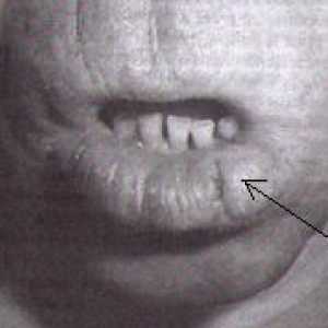 Rak wargi, jamy ustnej i gardła (gardła)