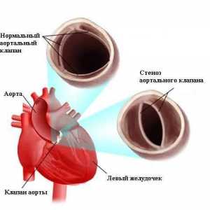Nabyta zwężeniem aorty (zwężeniem aorty)