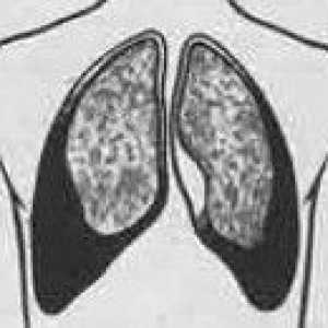 Suche zapalenie opłucnej