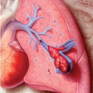 Zator tętnicy płucnej (PE),