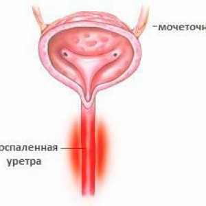Zapalenie cewki moczowej u kobiet