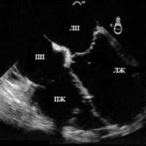 USG serca (echokardiografia)