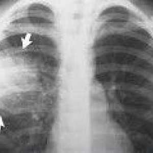 Szpitalne zapalenie płuc